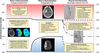 Management of Blood Pressure During and After Recanalization Therapy for Acute Ischemic Stroke